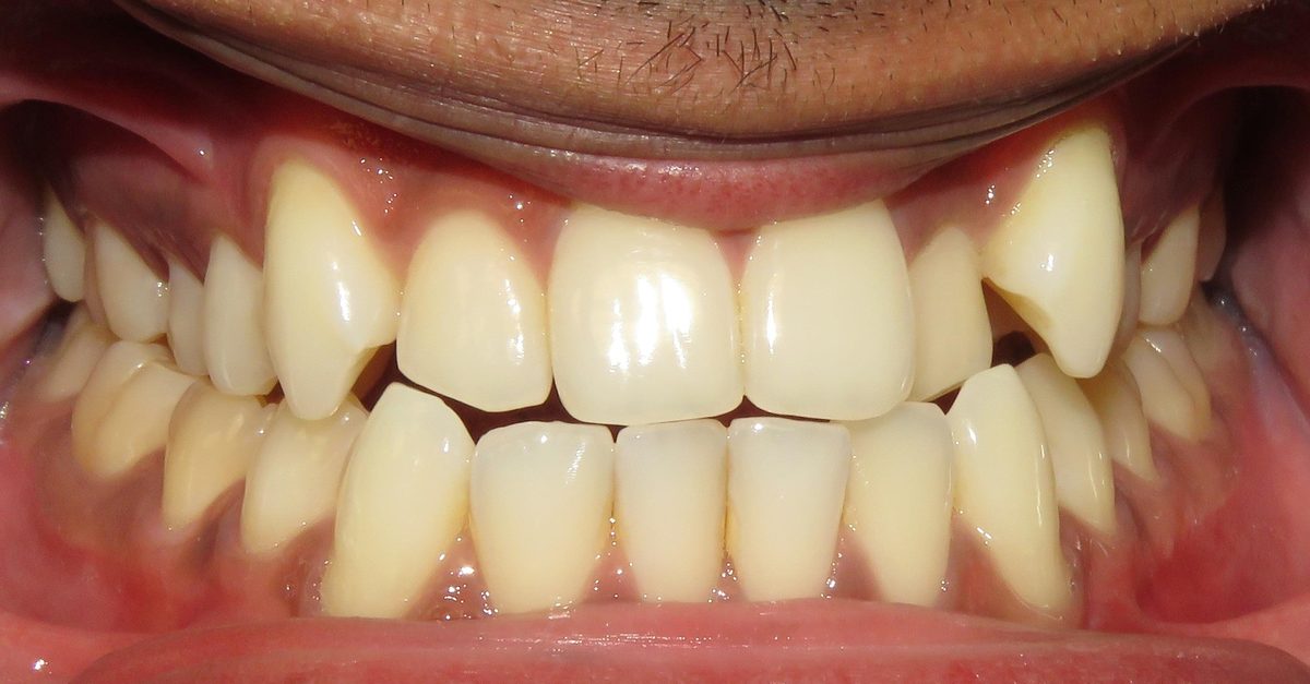 Vivid Smiles patient case 5 before and after treatment comparison before